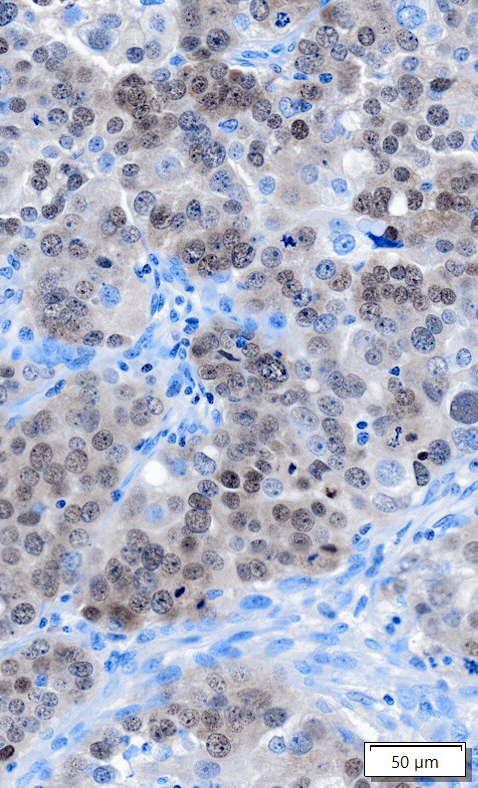Human Ovarian Cancer_Anti-MGMT Antibody_narrow