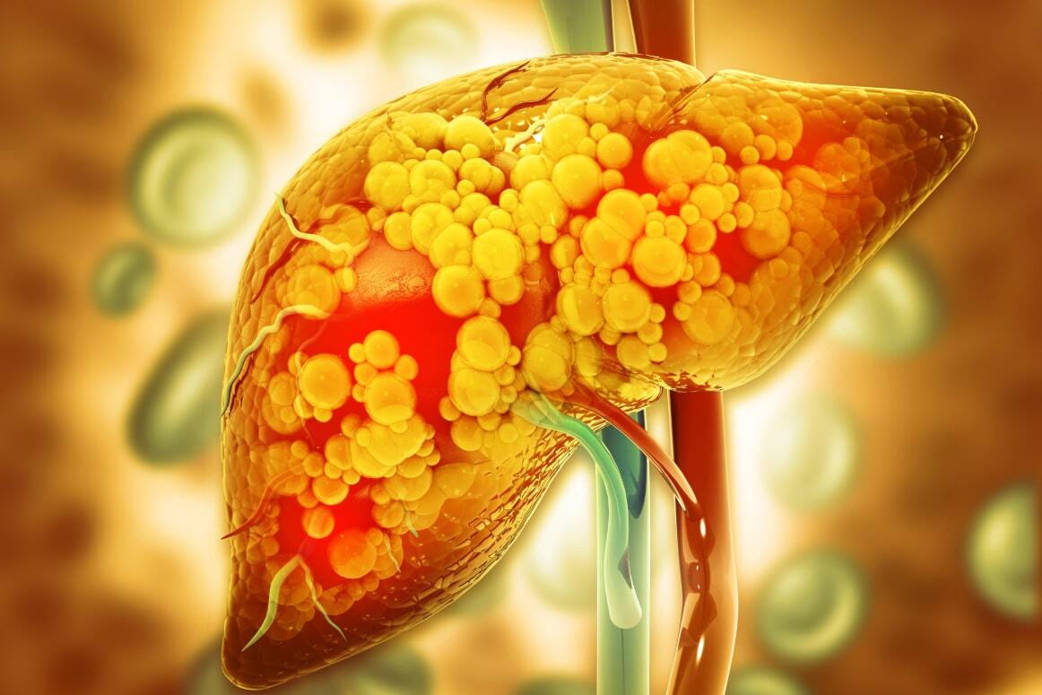 Metabolic Dysfunction-img